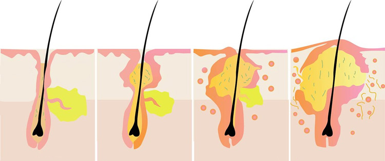 Sự tích tụ bất thường của các tế bào chết trong lỗ chân lông 1